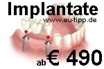 ZAHN-Behandlung CZ -günstiger als Ungarn- Implantate 490 Euro