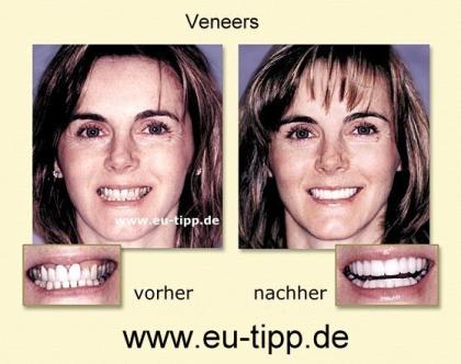 Zahnbehandlung CZ -günstiger als Ungarn- Implantate Euro 490