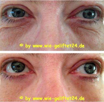 Faltenfrei in wenigen Minuten Anti-Aging der neuen Ära Sofort-Lifting pur